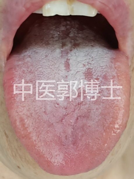 舌苔厚腻微黄用什么中药,下焦舌苔厚腻白用什么中药