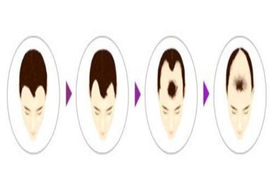 25岁男生脱发是因为肾虚嘛,男的脱发严重脸色也不好是肾虚吗