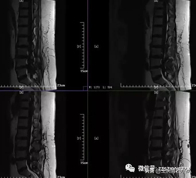 弯腰捡东西，腰痛腿麻大小便*禁失**，竞是腰椎间盘髓核脱出惹的祸