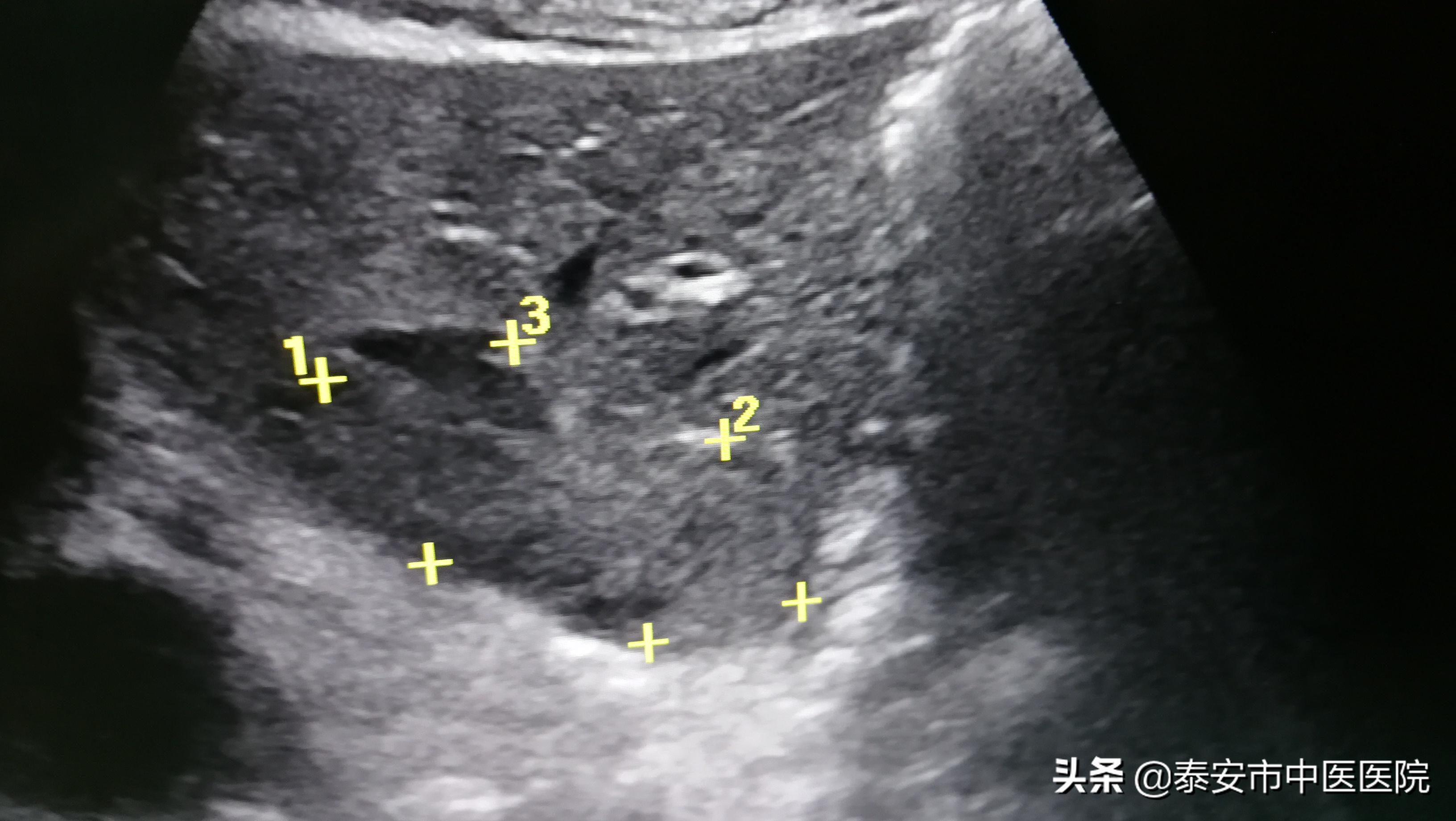 肝血管瘤射频消融术广东省中医院,射频消融治疗肝血管瘤需要住院吗