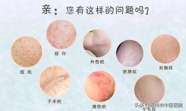 二氧化碳激光点阵掉痂后皮肤很干,二氧化碳点阵激光留下坑