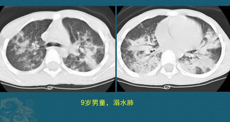 溺水后需要注意哪些事项,夏季溺水怎样防控