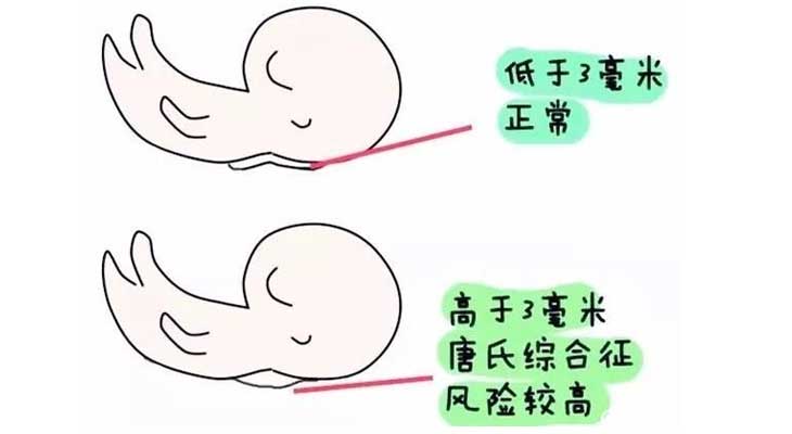 nt检查妈妈做什么运动,nt检查的孕妈妈