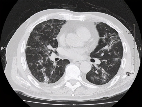 阵发性房颤和用药有关系吗,房颤药物控制好了还会复发吗