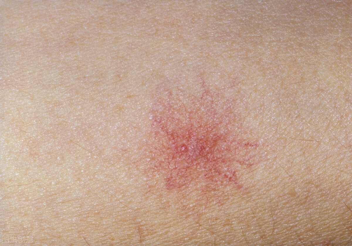 有肝掌但没蜘蛛痣就是肝病吗,出现肝掌和蜘蛛痣需要做什么检查