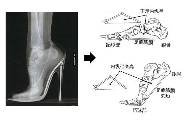 为了美，你愿意上麻药穿红色高跟鞋吗？