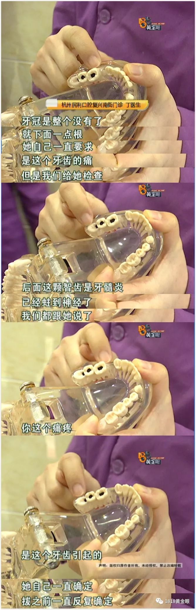 两次拔牙中间需要间隔多久,两次拔牙必须是一个医生吗