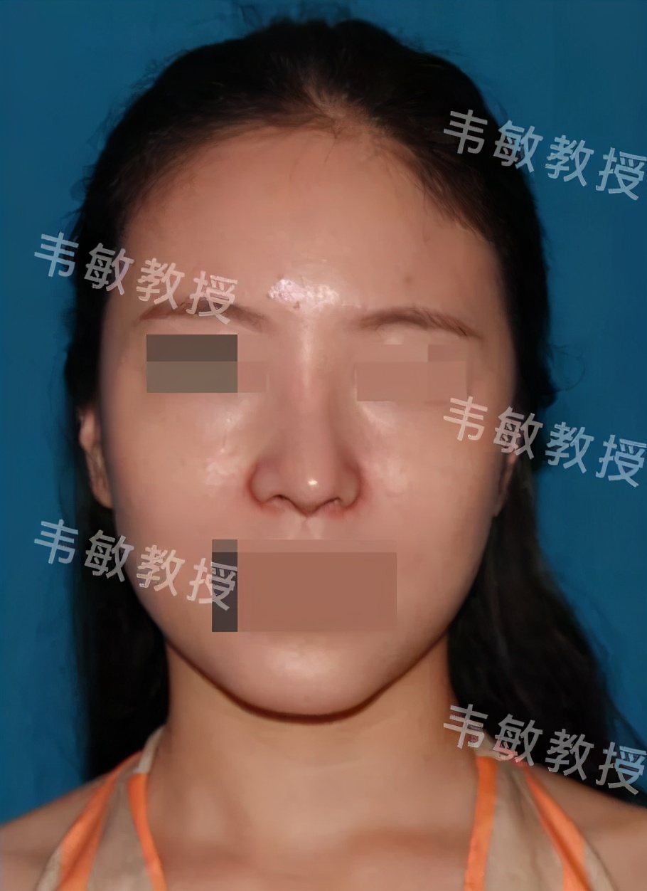 塌鼻子如何变成尖鼻子,形态欠佳怎么回事