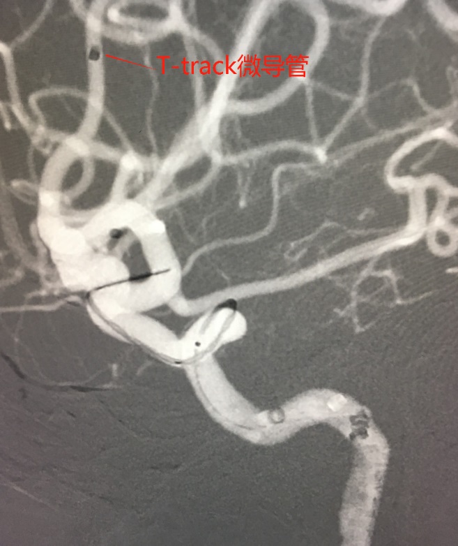 Tubridge®治疗多发性动脉瘤