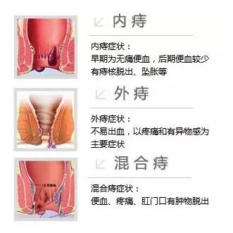 有痔疮的人教你几个食疗方,十人九痔的正确使用方法