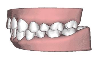 牙齿矫正有4个误区,牙齿矫正的副作用知多少
