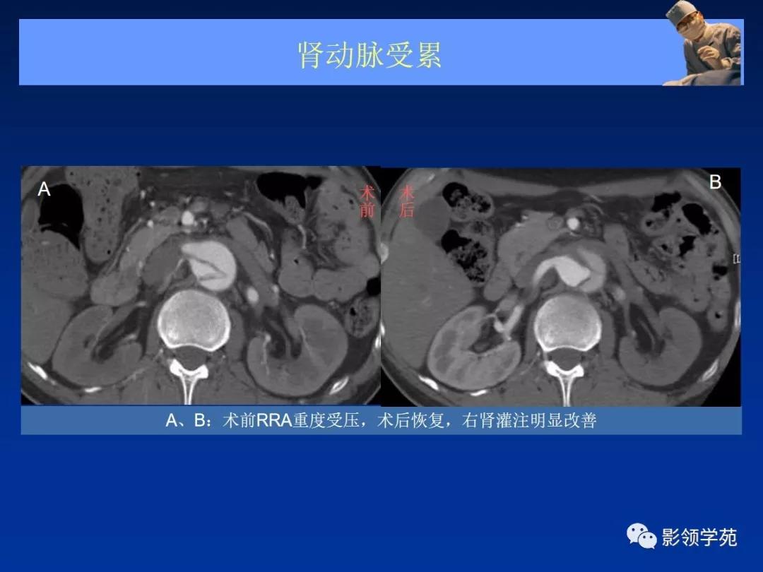 主动脉夹层壁间血肿如何鉴别,主动脉夹层血肿溃疡