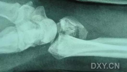 几种严重骨折医学名称,常见的骨折有哪些名称