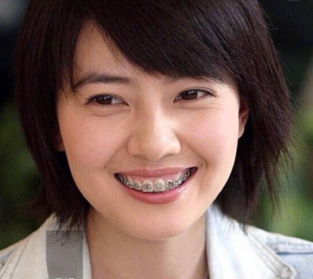 吴宣仪做牙齿前后对比,吴宣仪做整牙