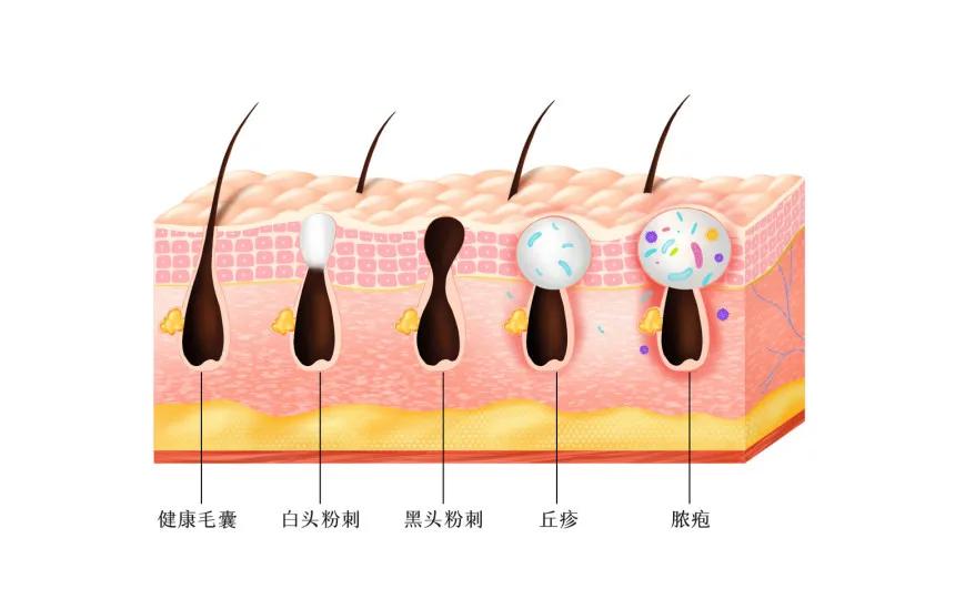 护肤后脸上有白色颗粒,脸上起白色小粒用什么护肤品
