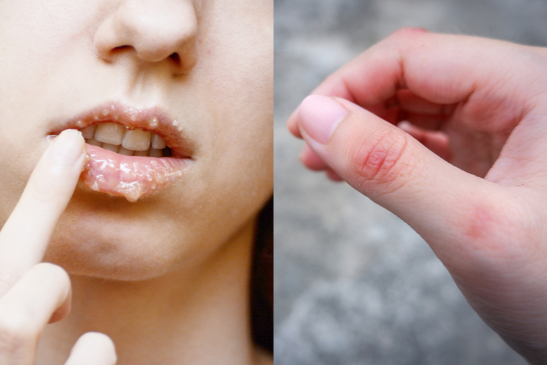 马油可以修复纹唇吗,马油能祛除旧疤痕么