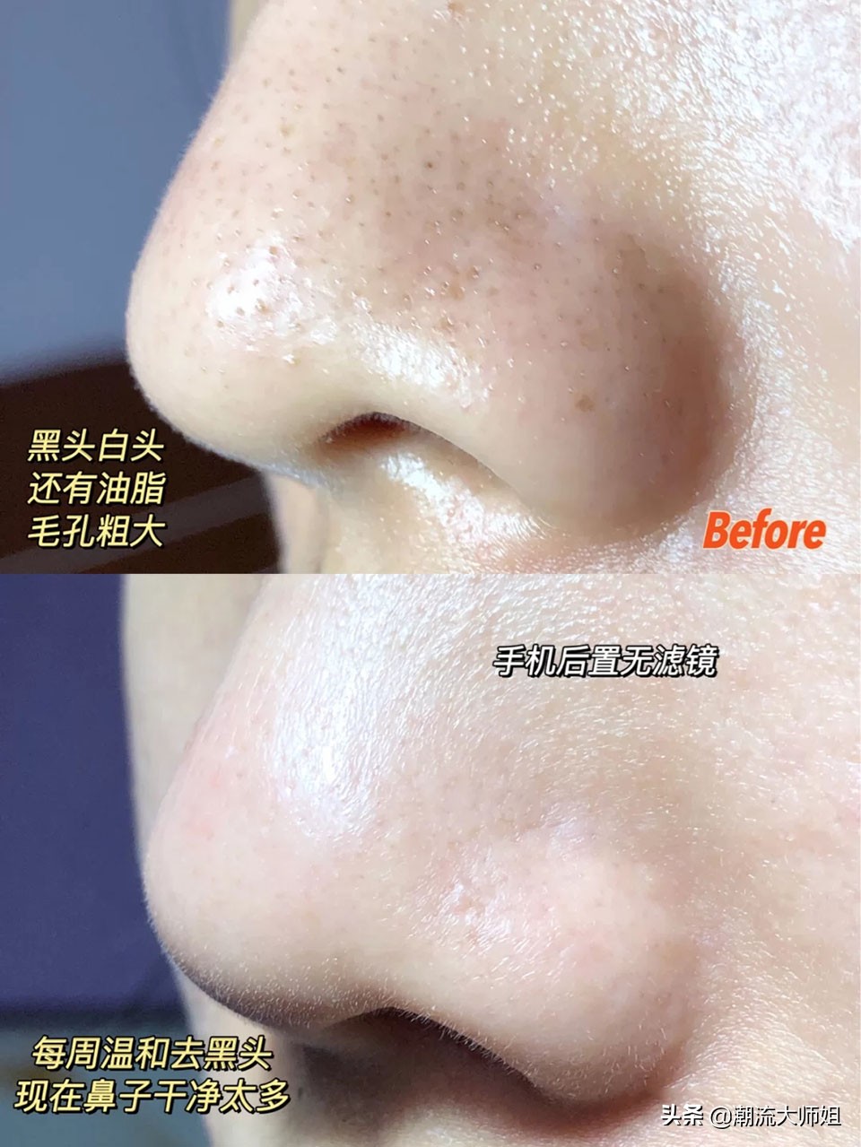 鸡蛋液去黑头有效吗,干货分享去黑头小诀窍让皮肤美腻