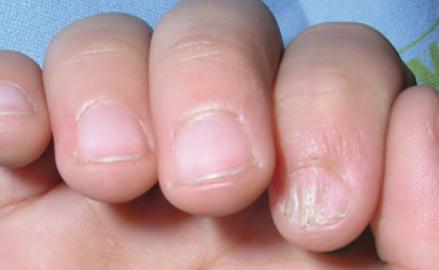 宝宝指甲出现白点,孩子指甲上有白色斑点倪海厦