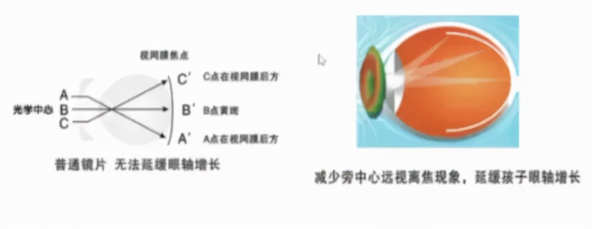 儿童屈光不正配镜专家共识,眼科医生吴夕教授