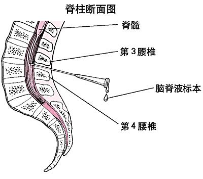 脑脊液检查结果都没事,脑脊液每次结果都不一样