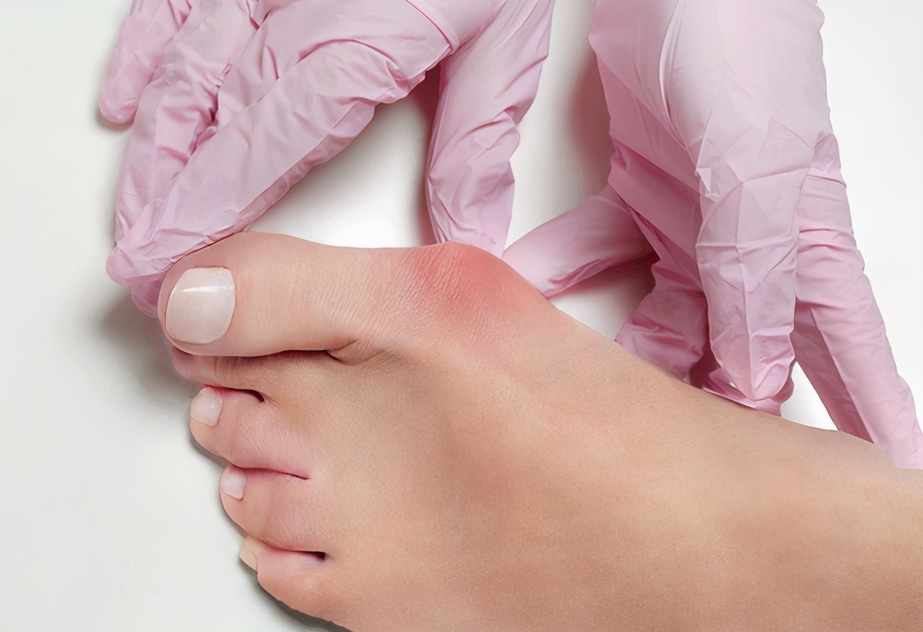 脚上长了病毒疣最简单的去除方法,脚病毒疣