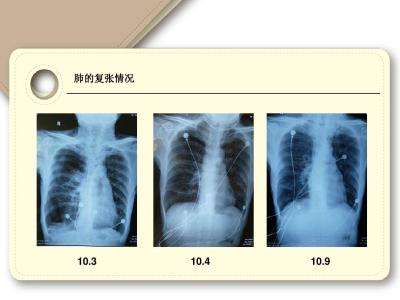 慢性阻塞性肺疾病处理措施,慢性阻塞性肺疾病最重要治疗措施