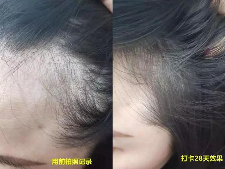 头油头皮屑多脱发洗发水,头油头皮屑多洗发水推荐