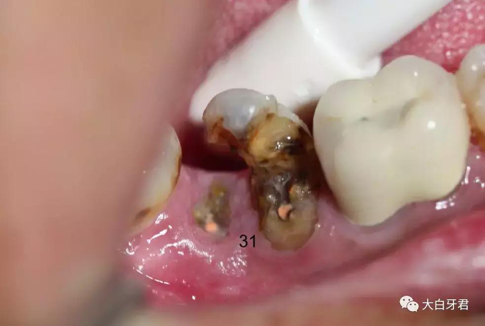 为了您健康远离槟榔,千万别乱吃槟榔