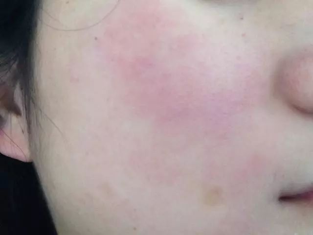 用了成百上千张化妆棉，皮肤却越来越薄了，原来是打开方式不正确