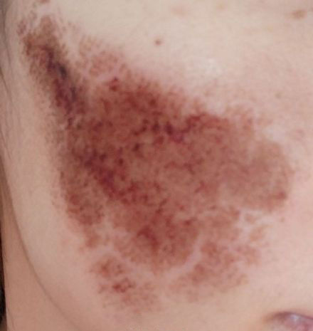 点阵激光能把伤疤完全修复吗,激光点阵可以修复到多少程度