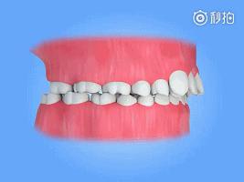 拔牙矫正的真实经历,拔牙矫正后悔的真实案例