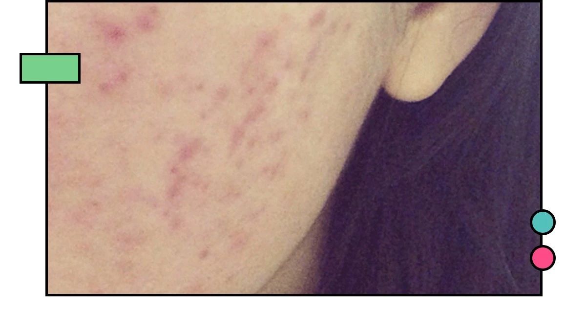 如何祛痘印？看了这篇能解决你大部分的问题！