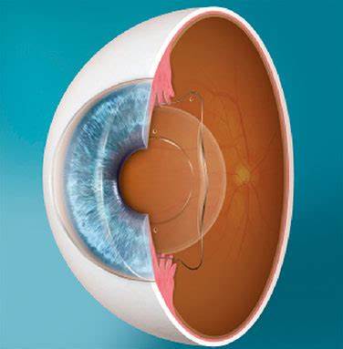 全飞秒半飞秒激光手术哪个更好,飞秒激光制瓣是全飞秒还是半飞秒