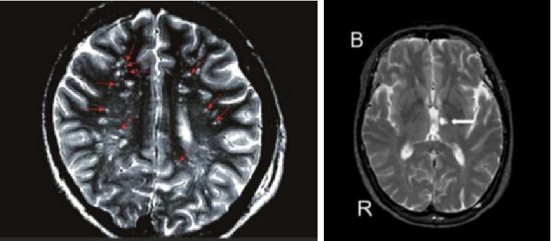 脑部CT腔隙性梗塞,脑部ct腔隙灶怎么看