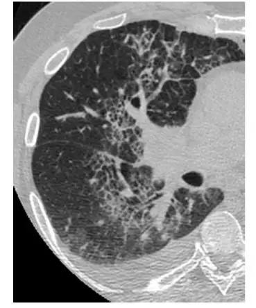 间质性肺疾病看病经验分享,分享肺腺癌临床实验的例子