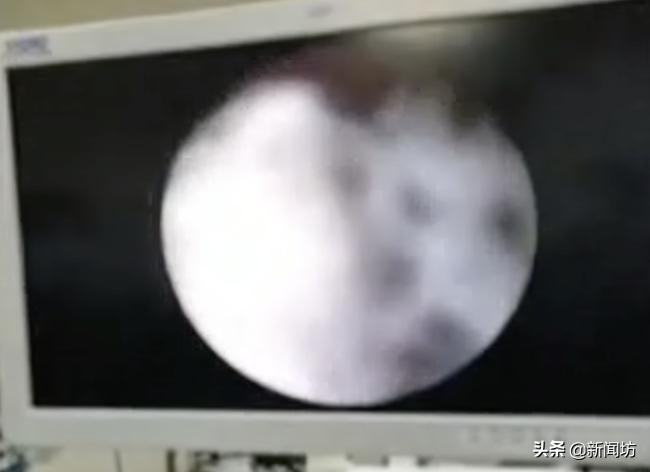 2岁女童*体下**间断性出血,还有异味!母亲怀疑性早熟,原因意外