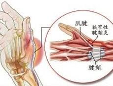 防治腱鞘炎最好的动作,预防腱鞘炎的关键有哪些