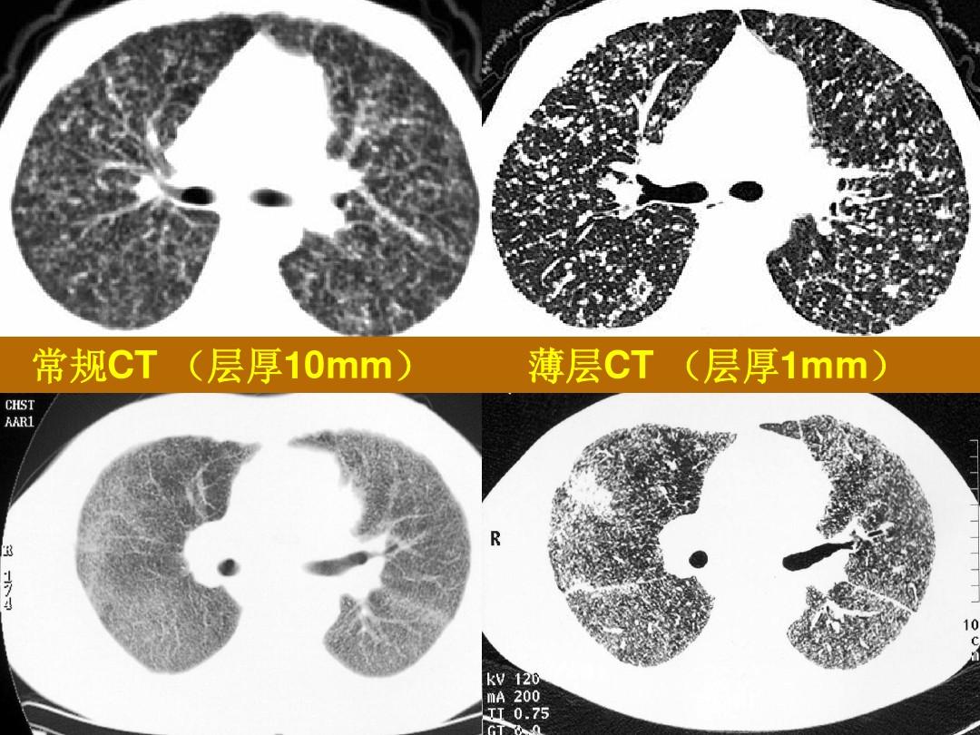 特发性肺纤维化，一种炎症因子导致的疾病，目前有两种药可治疗