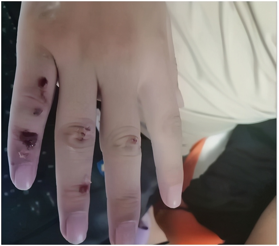 磕断了一排牙,磕断了一半门牙