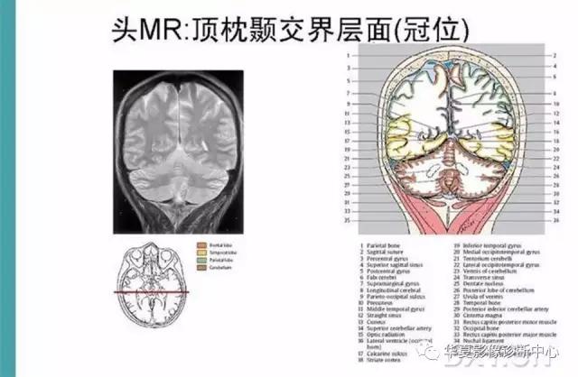 电子版头颅ct与mri断层解剖,头颅mri血管解剖与分段详解