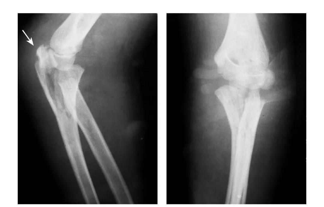 青少年肘部损伤最常见的是,肘部桡神经损伤的临床表现