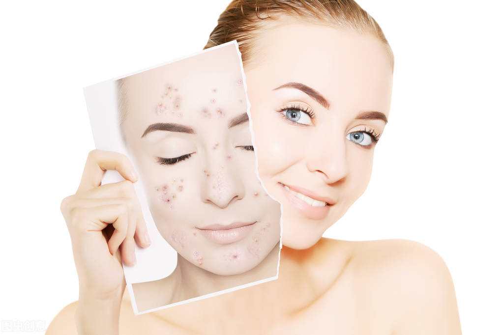 有痘痘如何正确敷面膜,敷面膜对痘痘会有什么影响吗