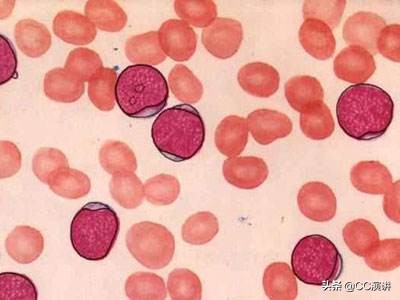 白血病不是不治之症单倍体移植如何破解白血病难题?