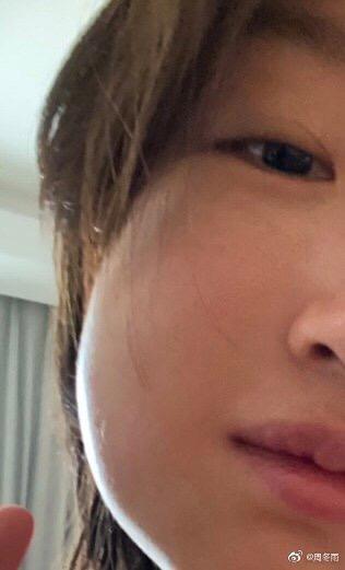 智齿必须拔掉的五种情况图片,智齿一定要拔吗4种情况必拔