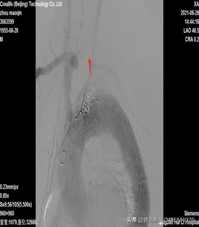 海慈血管外科中心开展高难度杂交手术为患者解除胸主动脉弓动脉瘤危机