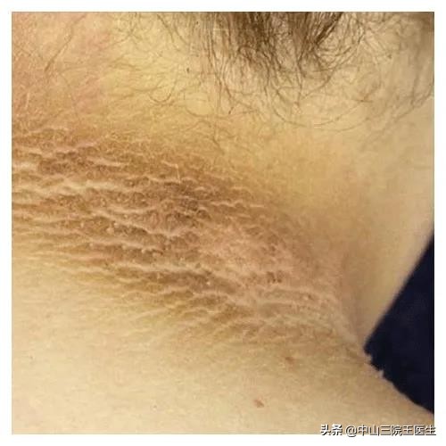 判断是没洗干净还是假性黑棘皮病,黑黑的洗不掉怎么办