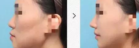 协和整形美容科专家,北京协和整形鼻综合