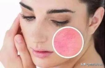 修复角质层薄红血丝敏感肌软膜,修复角质层薄红血丝敏感肌妙招