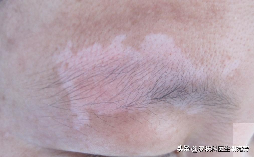 白斑就算白癜风么,花斑癣白斑和白癜风白斑的区别