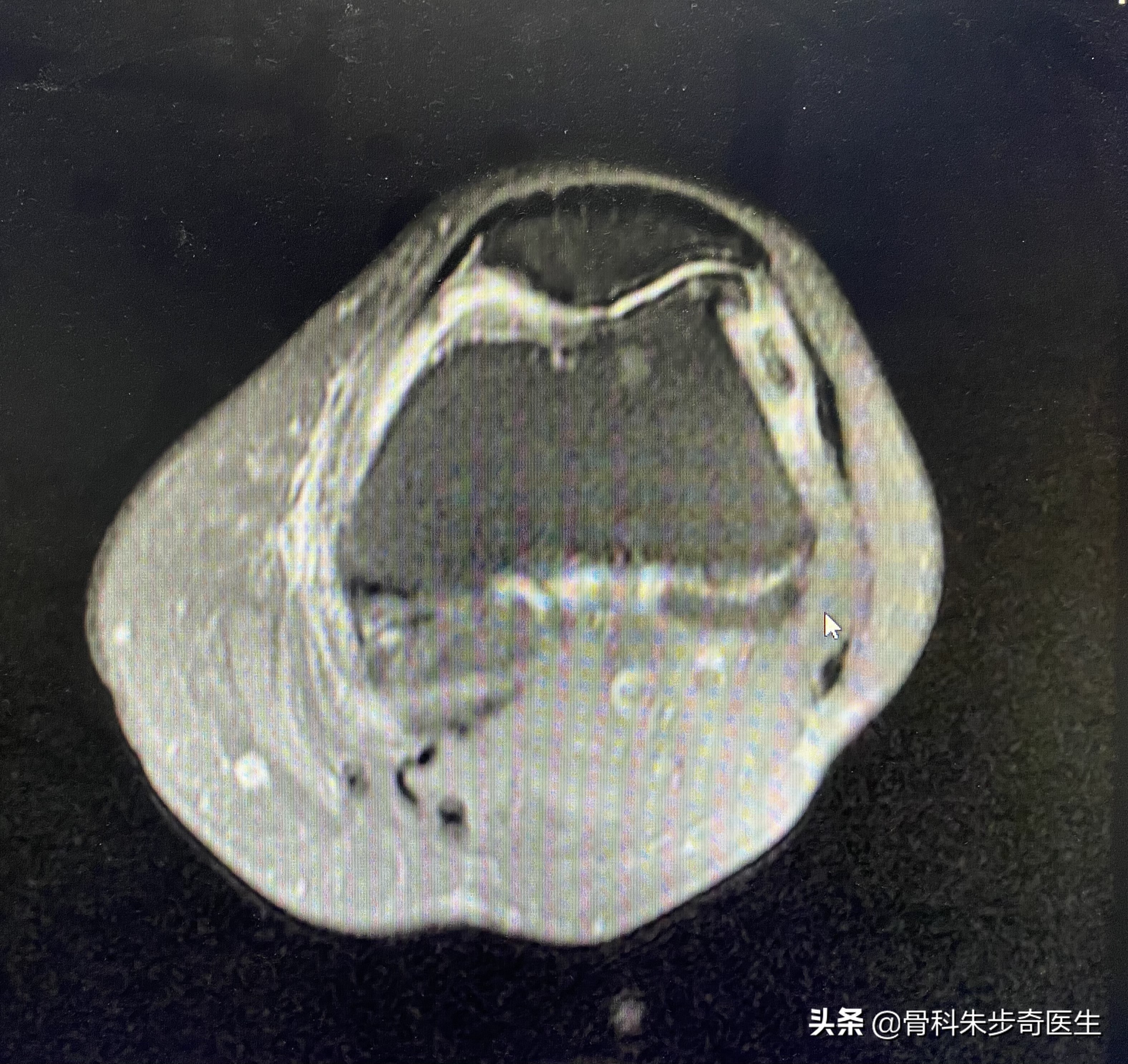 膝关节上面的骨刺该怎么解决,年轻人膝关节骨刺是怎样引起的
